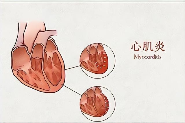 心肌炎的癥狀有哪些?心肌炎的主要變現癥狀有啥? 心肌炎的癥狀有哪些?心肌炎的主要變現癥狀有啥?